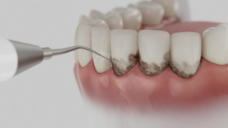 Trusted Wisdom Tooth Removal service in Henryetta, OK - Dentist Open Now